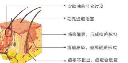 夏天到了,油性肌肤怎么祛痘