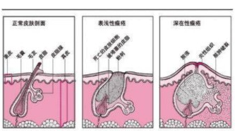 夏天到了,油性肌肤怎么祛痘